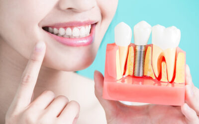 Qual a importância do Implante Dentário: conheça as vantagens!
