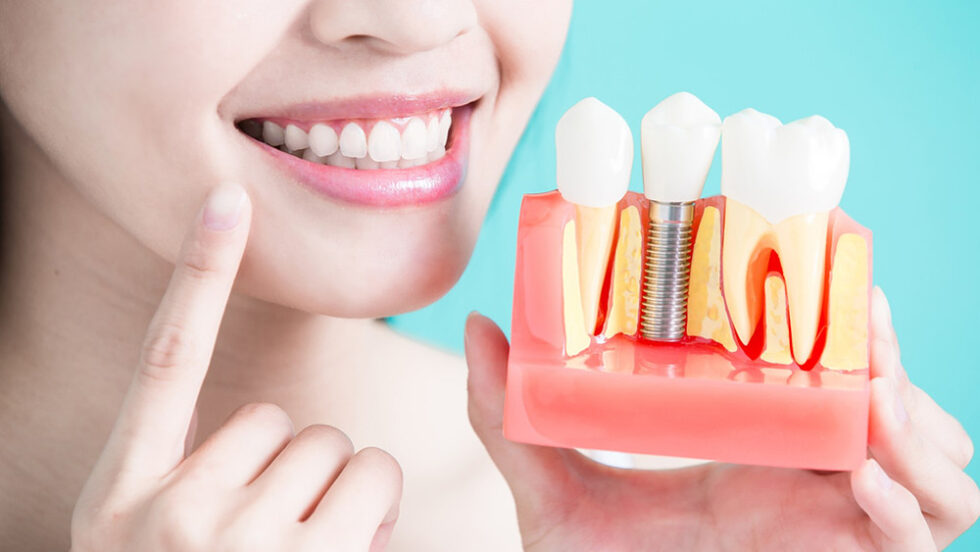 Qual A Importância Do Implante Dentário: Conheça As Vantagens! | OdontoLike