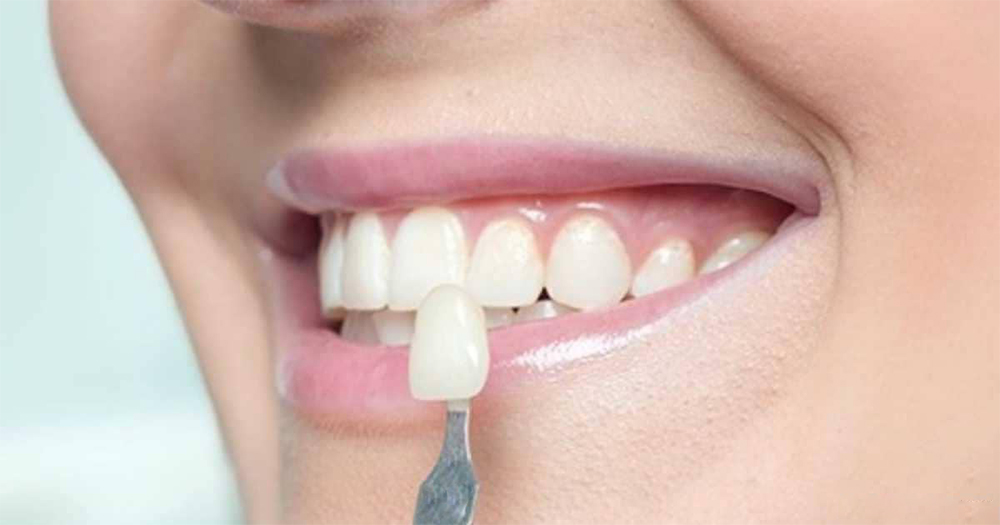 Lentes de contato Dental em Porcelana