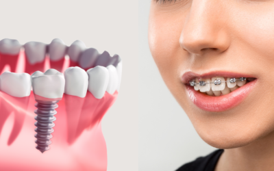 Implante Dentário X Aparelho Ortodôntico: